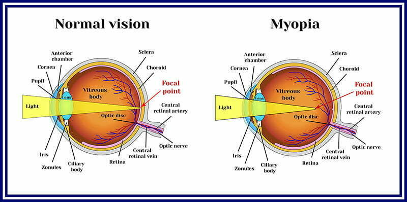 Myopia FAQs