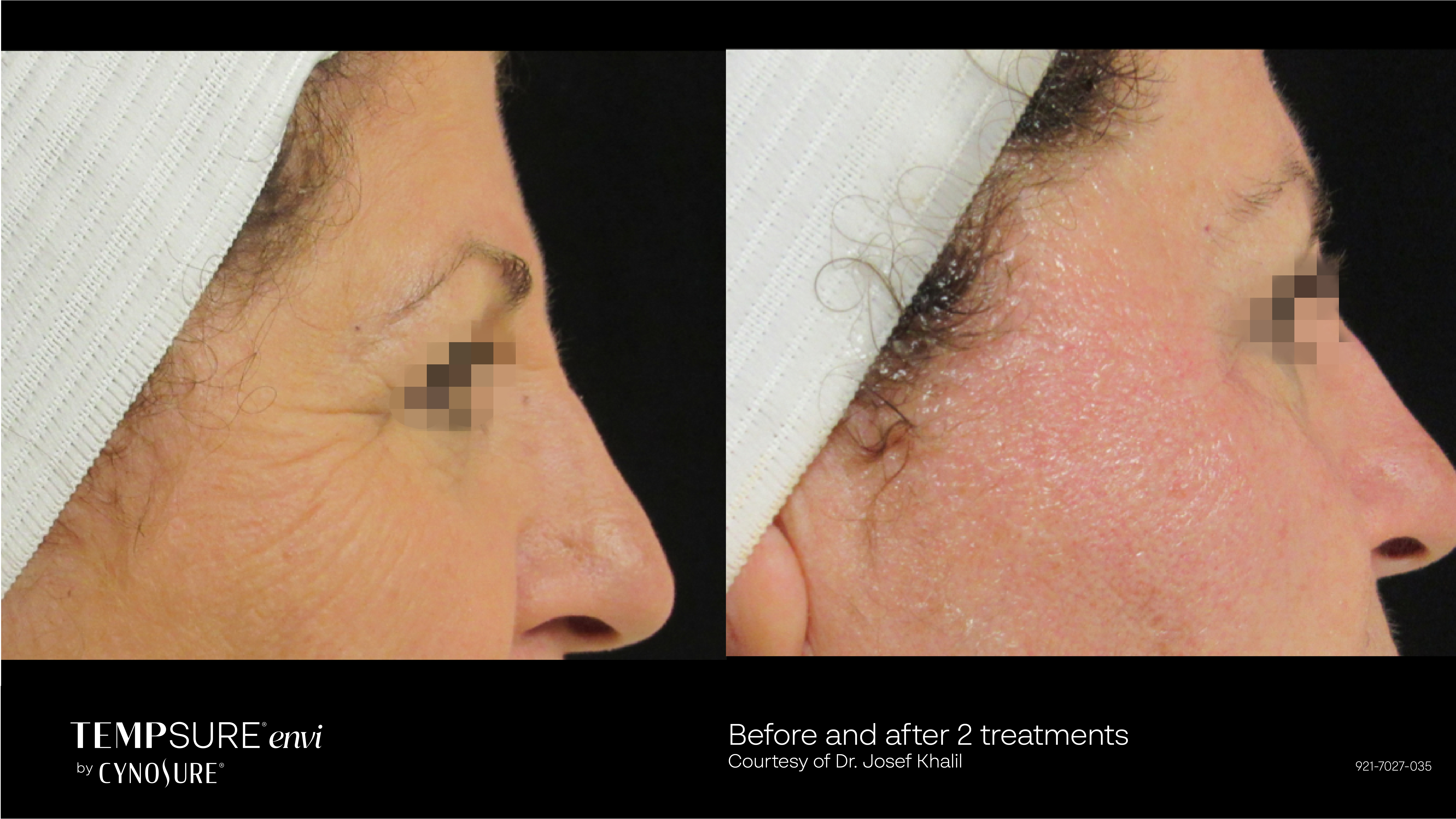 Crows Feet TempSure Envi Before and After