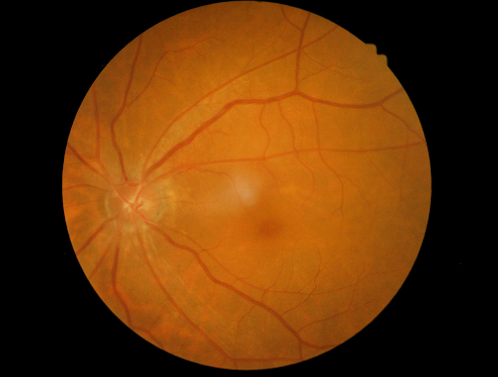 Image of an eye with Diabetic Retinopathy