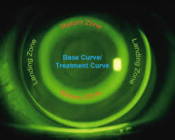 Corneal Refractive Therapy (CRT)