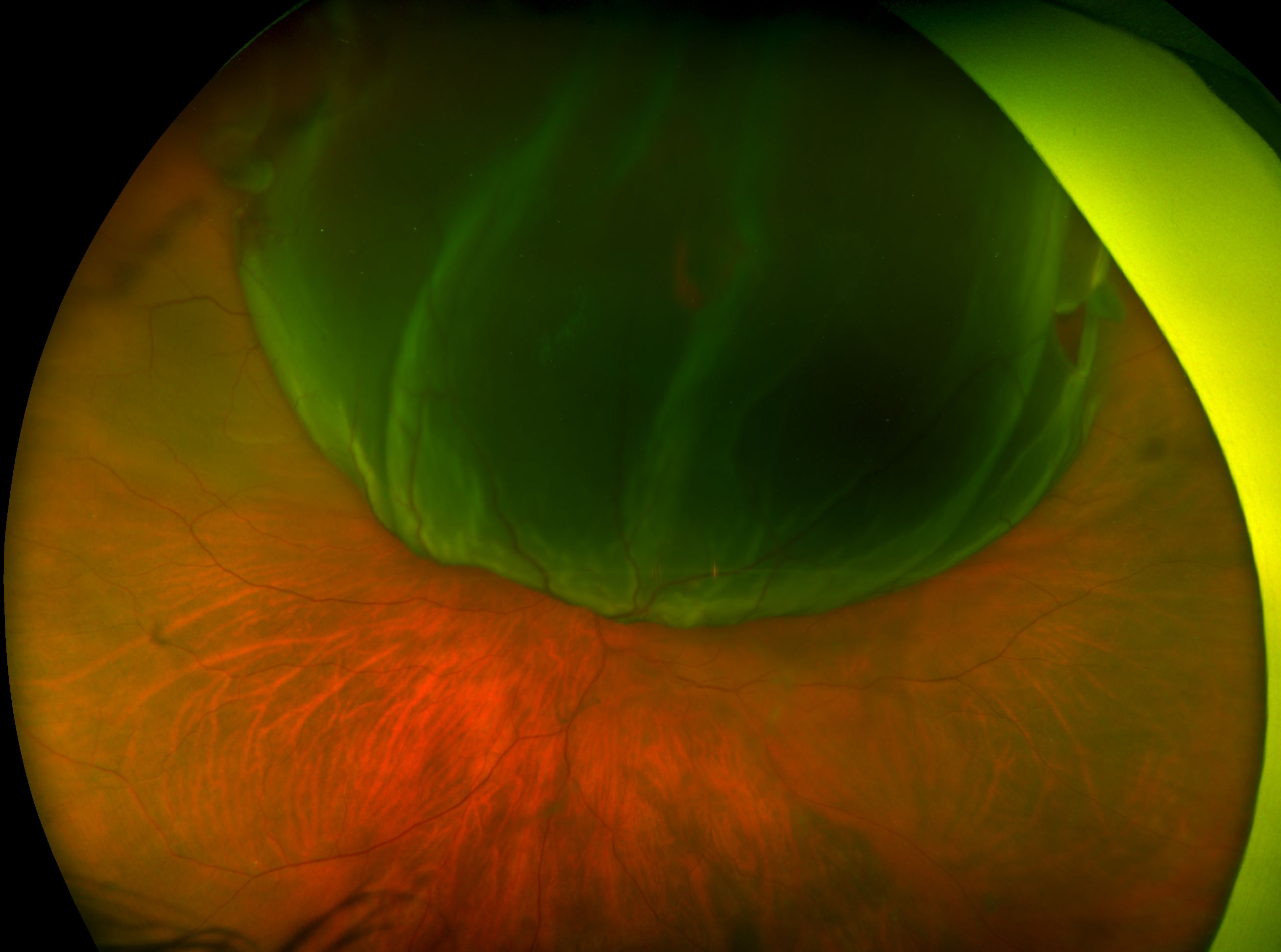 Optos Retinal Detachment