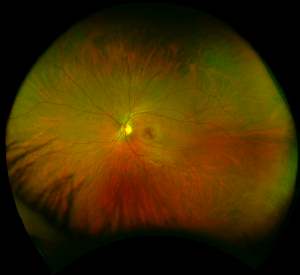 Optos Healthy Retina