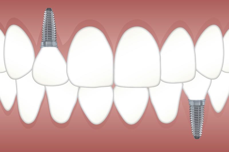 Dental Implant Bay City Dentist