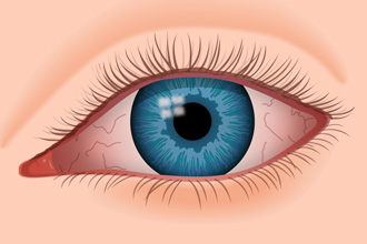 As shown here, dry eyes can become red and irritated.
