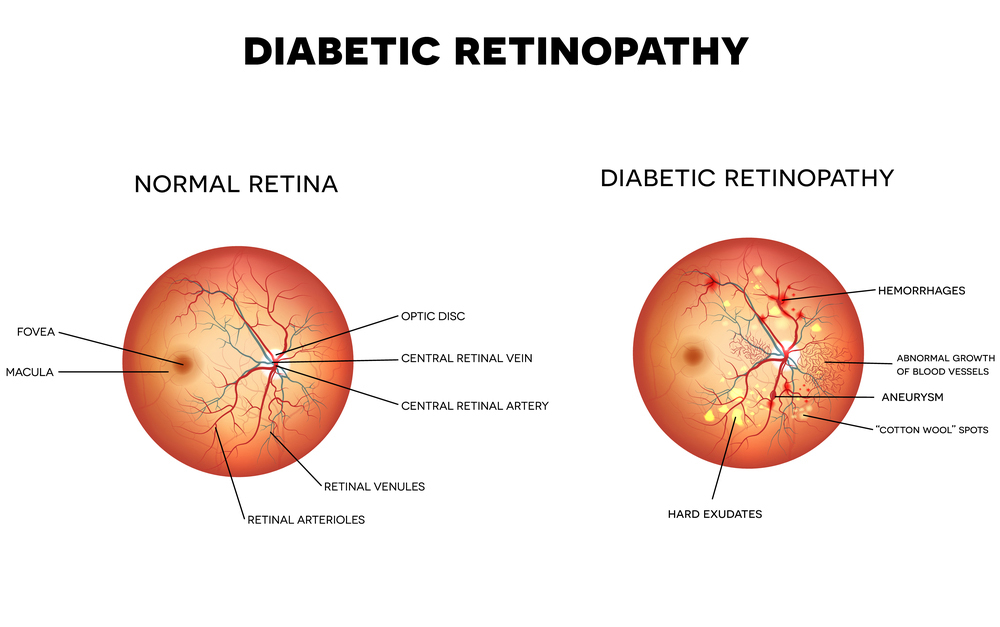 Diabetic Retinopathy vs Normal Eye