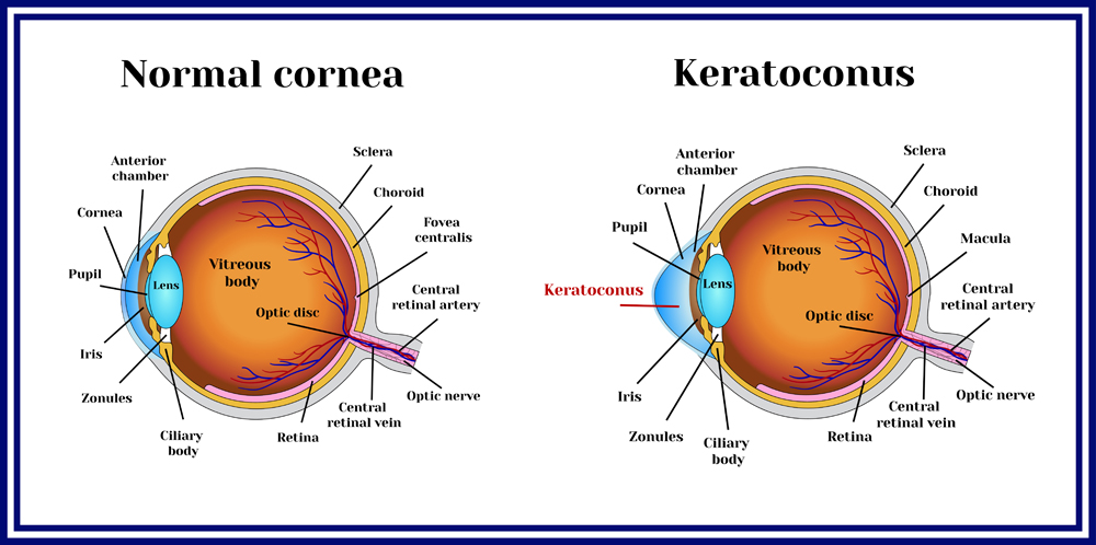 Keratoconus vs Normal cornea