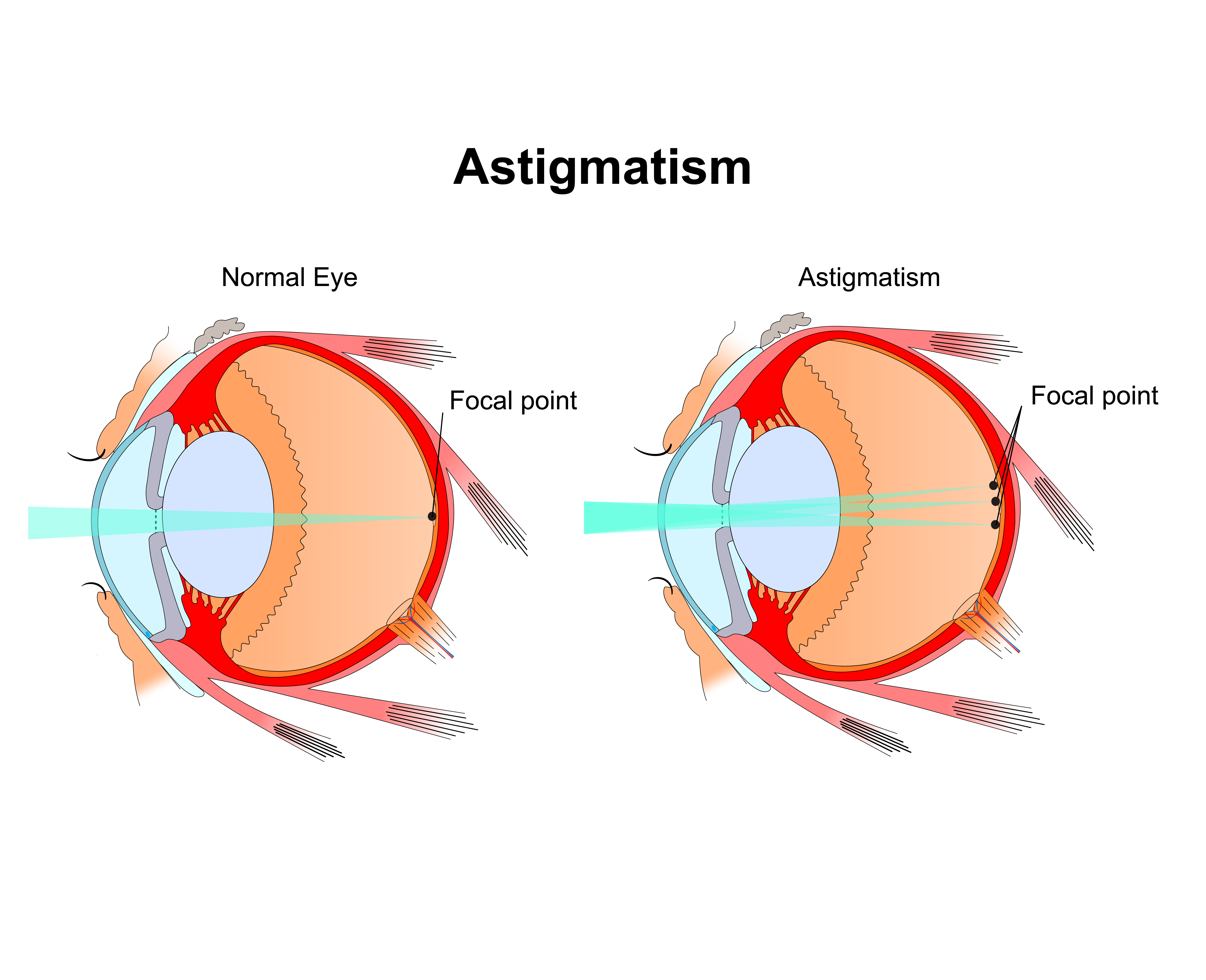 diagram of normal eye vs eye with astigmatism 
