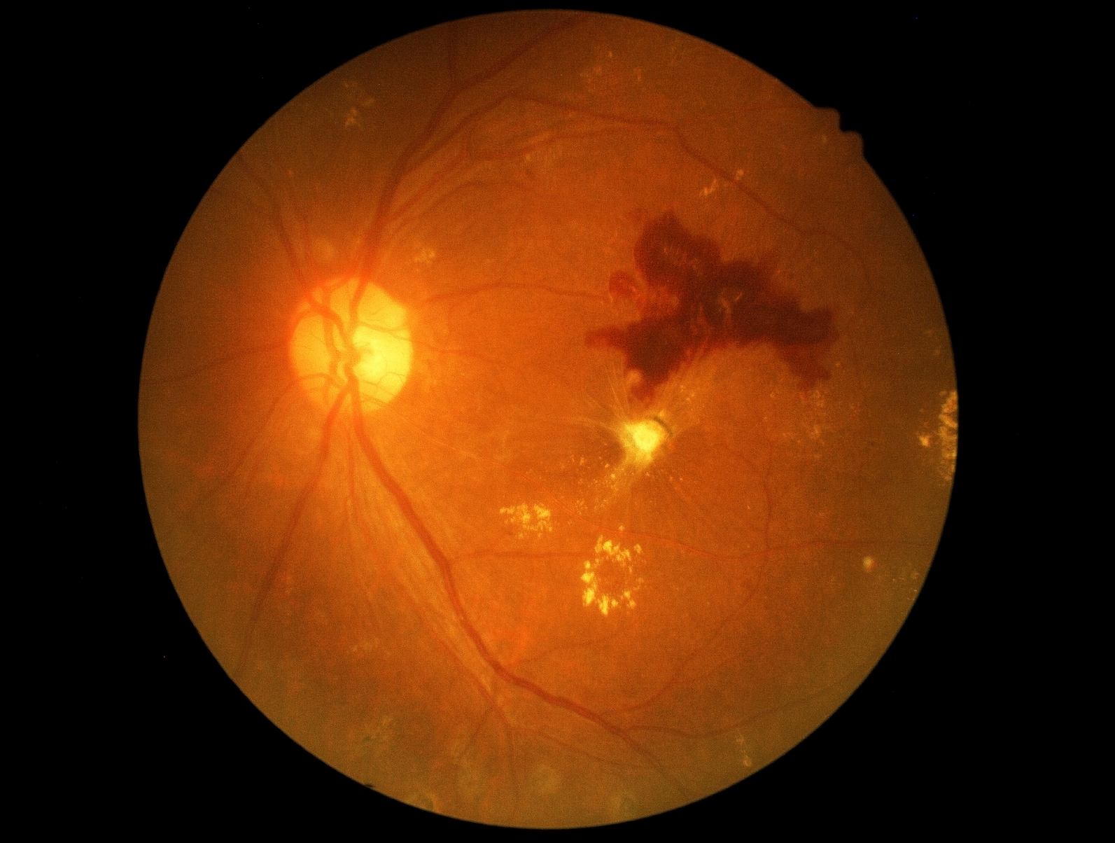 website-diabetic-retinopathy.jpg