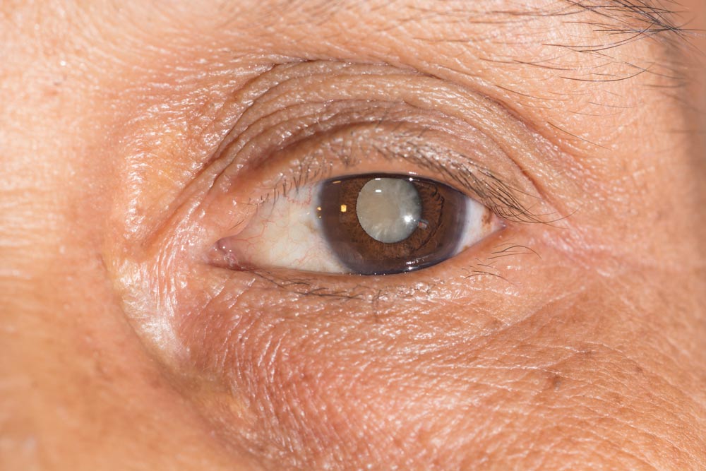 Cataract Surgery at Eye Specialists of Illinois