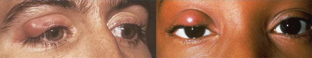 eyelid chalazion