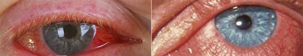 viral conjunctivitis