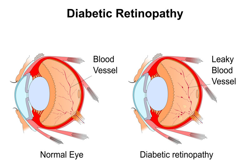 Diabetic Retinopathy