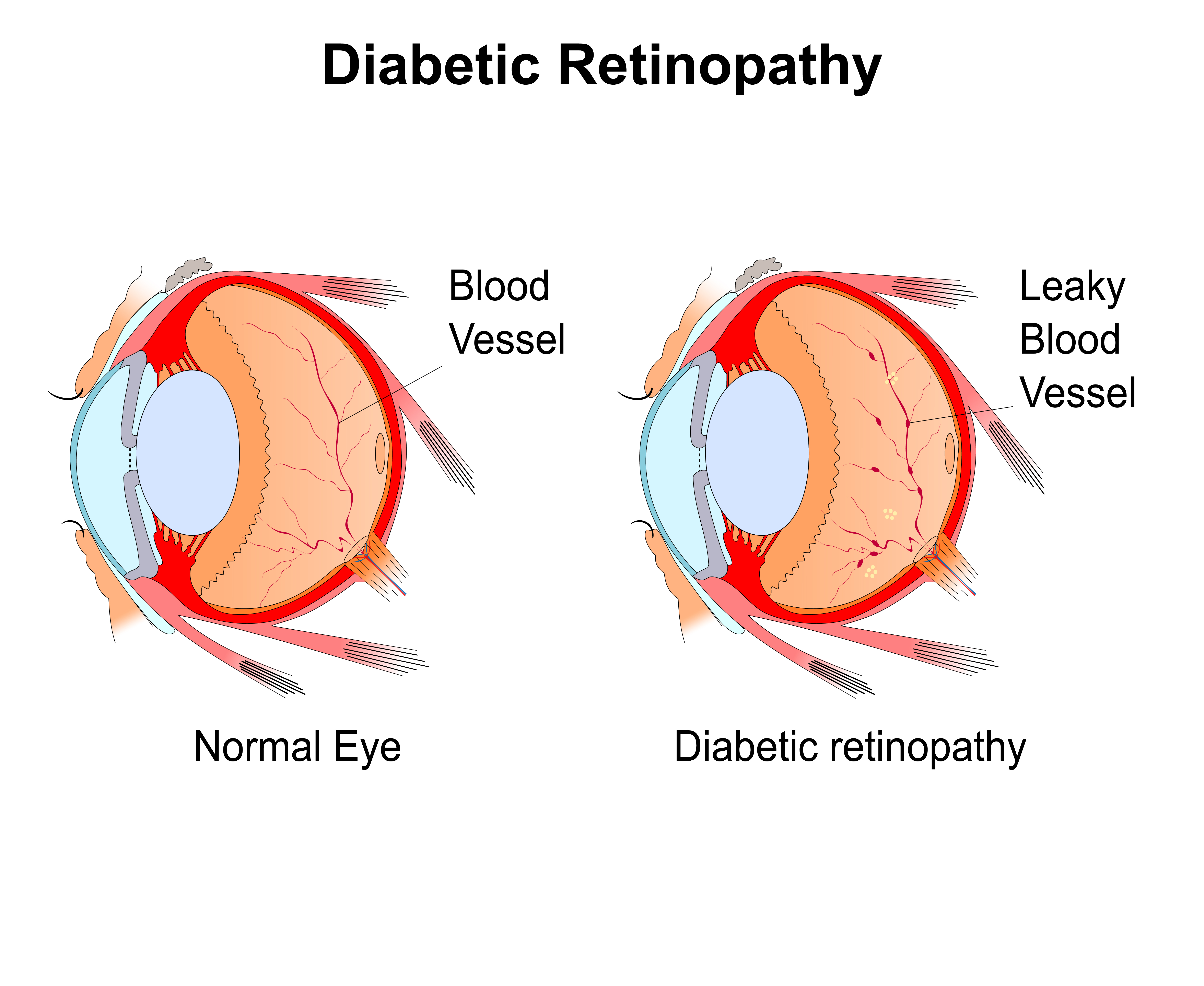 Diabetic Eye Diagram