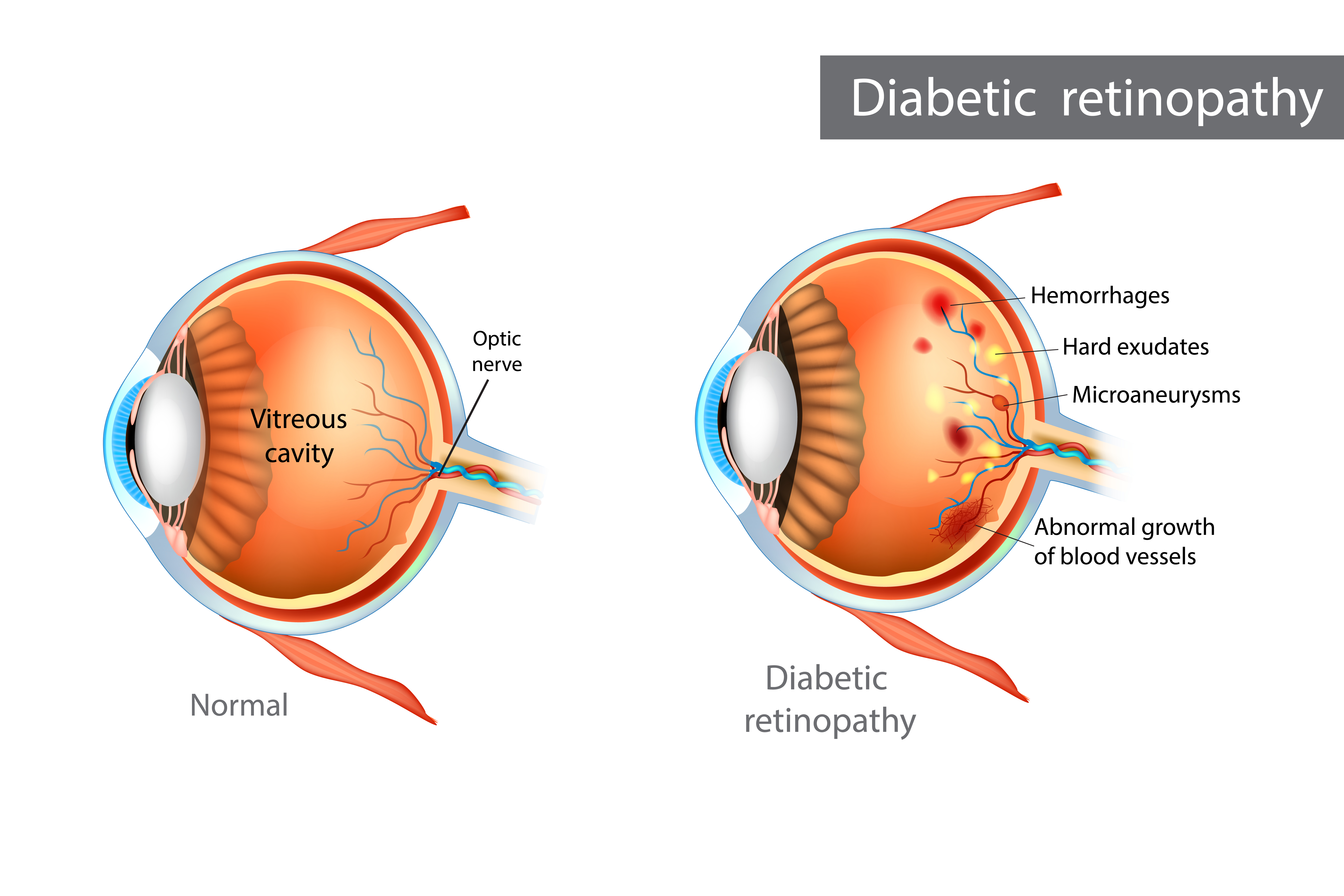 Diabeic_Retinopathy